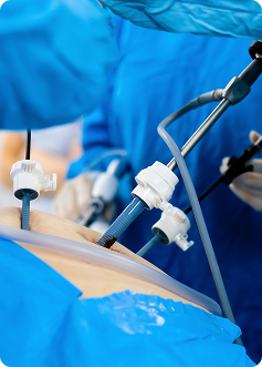 Immagine chirurgia laparoscopica: strumenti sottili entrano nell’addome tramite piccoli accessi, monitor azzurro e profili di bisturi e trocar.