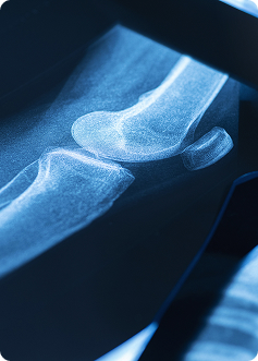 Radiografia di un ginocchio, vista di ossa e contorni articolari su sfondo blu, dettaglio di superficie e strutture ossee.